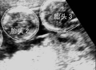 福州总院和省妇幼试管婴儿各有优势，并不存在孰好孰坏